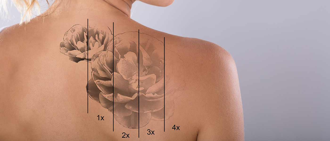 Laser Tattoo Removal with Florida Society of Plastic Surgeons